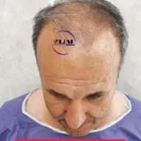 کاشت مو و ابرو|خدمات آرایشگری و زیبایی|قم, پامنار|دیوار