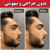 آف فرمدهی بینی بدون عمل جراحی پزشک پوست مو زیبایی|خدمات آرایشگری و زیبایی|مشهد, هفت تیر (آب و برق)|دیوار