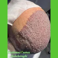 کاشت مو طبیعی