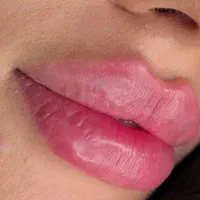 تزریق ژل۶۰۰