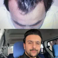 کاشت مو تبریزقیمت مناسب اقساطی فول تراکم|خدمات آرایشگری و زیبایی|صوفیان, |دیوار