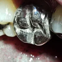 دندانپزشکی/کامپوزیت/عصبکشی/روکش/ترمیم و پالیش|خدمات آرایشگری و زیبایی|قدس, شهرقدس|دیوار