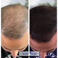 رفع کم پشتی مو با میکرو اسکالپ/ جایگزین کاشت مو|خدمات آرایشگری و زیبایی|مشهد, وکیلآباد|دیوار