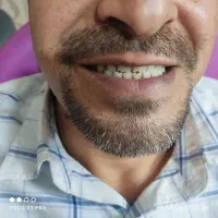 دندانپزشکی کامپوزیت(دندان مصنوعی) (اقساط ۱۰ ماه)|خدمات آرایشگری و زیبایی|قم, حکمت شمالی|دیوار