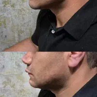 تزریق ژل و بوتاکس فیلر فیبروز لیزر