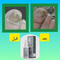 درمان ترک پا ومیخچه