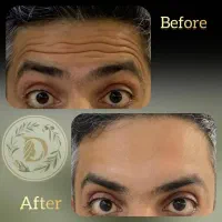 جشنواره بوتاکس پاییزه فقط تا پایان آبان ماه|خدمات آرایشگری و زیبایی|اصفهان, جلفا|دیوار