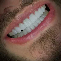 ایمپلنت دندان کره‌ای با روکش رایگان 15/500تومان