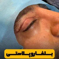 بلفارو پلاستی( جراحی پلک بالا و پایین)