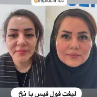 لیفت صورت با نخ و تزریق فیلر در کلینیک زیبایی