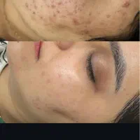 فیشال پوست برای خانمهاوآقایان|خدمات آرایشگری و زیبایی|کرمانشاه, |دیوار