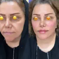 ژل تمام نقاط صورت فقط ۵۵۰تا دوشنبه