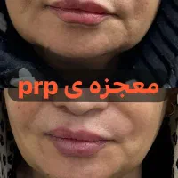 جشنواره بوتاکس ۷۹۰پی آرپی۶۵۰ فیلر۷۵۰