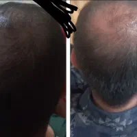 درمان ریزش مو صددرصد گیاهی و تضمینی