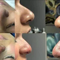 پلاسما جت وخال برداری و|خدمات آرایشگری و زیبایی|قم, کیوانفر|دیوار