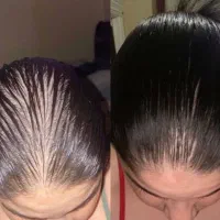 درمان انواع مشکلات مو(تضمینی)