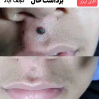 خال صورت/لکه های پوستی/لیزرموسفید/ریموتتو/بوتاکس|خدمات آرایشگری و زیبایی|نجف‌آباد, بازار|دیوار