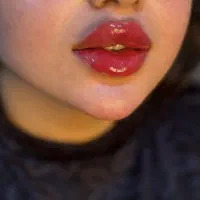 بوتاکس ، ژل ، نخ ، مزو ، فیلر بادی