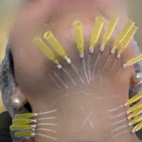 نخ جوان ساز ۳۰ درصد تخفیف توسط پزشک