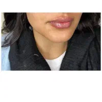 بوتاکس،فیلر،مزوژل باتخفیفی که نمی‌خوای از دست بدی|خدمات آرایشگری و زیبایی|شیراز, میرزاکوچک خان|دیوار