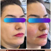 بمب تخفیف خدمات زیبایی ژل بوتاکس جوانساز بادی|خدمات آرایشگری و زیبایی|اهر, |دیوار
