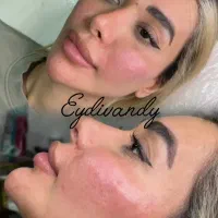 ژل و بوتاکس