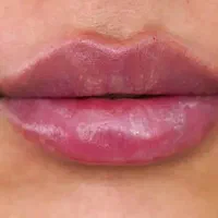 فیلر لب|خدمات آرایشگری و زیبایی|مشهد, رده|دیوار