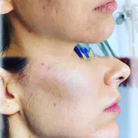 تخفیف عیدانه تزریق ژل،بوتاکس،فشیال.لیزر|خدمات آرایشگری و زیبایی|تهران, نیروی هوایی (پیروزی)|دیوار
