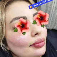 ژل سی سی۵۰۰ پرسینگ، چال گونه