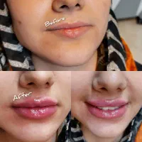 تزریق فیلر وبوتاکس  باچک صیادی