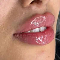 مزو ژل فیلر و بوتاکس 950گونه فولفیس زاویه لب واکسن