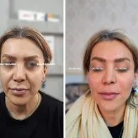 تزریق ژل (فیلر) وبوتاکس و لیفت بانخ ومادلینگ|خدمات آرایشگری و زیبایی|تهران, هفت حوض|دیوار
