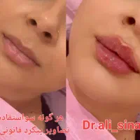 جشنواره تزریق فیلر و ژل و بوتاکس در قلب پزشکی مشهد|خدمات آرایشگری و زیبایی|مشهد, احمدآباد|دیوار