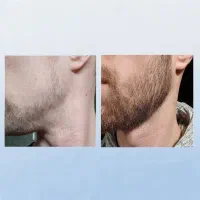 تقویت و احیای ریش تو