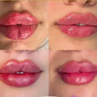 تزریق ژل وبوتاکیس|خدمات آرایشگری و زیبایی|بجنورد, |دیوار