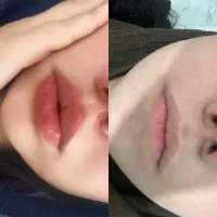 فیلر بادی ۱۰۰cc15m ژل و بوتاکس ۵۵۰ امبدینگ ۱/۲۰۰