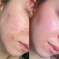جوان سازی پوست صورت