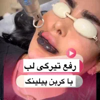 لیزربرطرف کننده جوش صورت و روشن سازی تیرگی های بدن