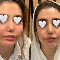 بهترین دکتر تزریق چربی تهران|خدمات زیبایی و سلامت|تهران, سعادتآباد|دیوار