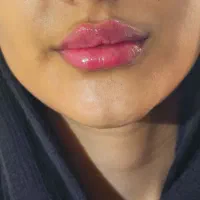 تزریق فیلر بادی بدن۱۲۰هزار|خدمات آرایشگری و زیبایی|جوانرود, |دیوار