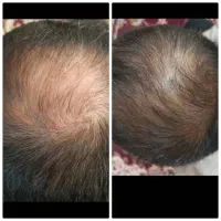 رویش مو با دمنوش و روغن های معجزه آسا