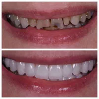 لبخندی رویایی با متریال برند های برتر کامپوزیت|خدمات آرایشگری و زیبایی|یاسوج, |دیوار