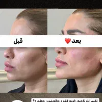 ژل و بوتاکس|خدمات آرایشگری و زیبایی|شیراز, زرهی|دیوار