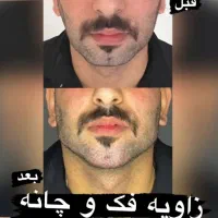 تزریق ژل و بوتاکس|خدمات آرایشگری و زیبایی|اصفهان, گلزار|دیوار