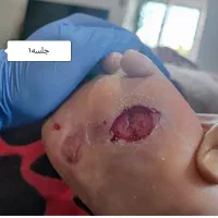 کارشناس زخم/ درمان زخم