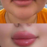 تزریق و آموزش ژل و بوتاکس با مدرک پیراپزشکی