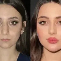 جشنواره بهاری  ژل فیلر بوتاکس سابسیژن