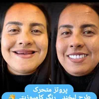 ساخت دندان مصنوعی جلوه طبیعی طرح لبخند|خدمات آرایشگری و زیبایی|سبزوار, امیر کبیر|دیوار