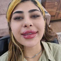 بوتاکس به مدت ۲روز ۶۵۰ تومان ،آموزش ۳.۸۵۰