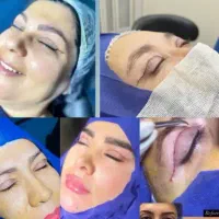 بلفارو پلک.لیفت تخصصی شقیقه ابرو صورت غبغب|خدمات زیبایی و سلامت|شیراز, معالی‌آباد|دیوار